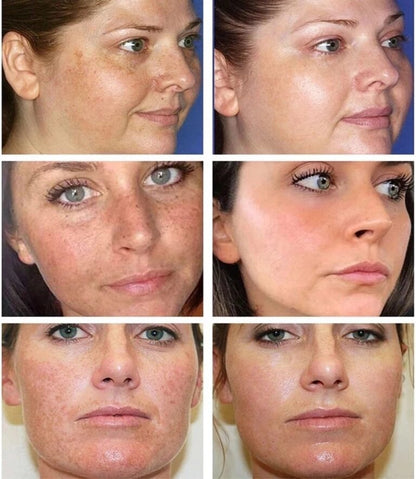 Bruine vlekken Verwijderen | Sproet Creme | Pigmentvlekken Verwijderaar