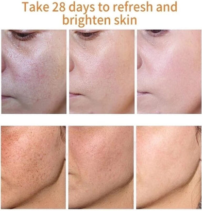 Bruine vlekken Verwijderen | Sproet Creme | Pigmentvlekken Verwijderaar
