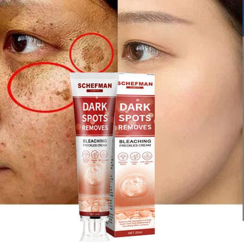 Bruine vlekken Verwijderen | Sproet Creme | Pigmentvlekken Verwijderaar