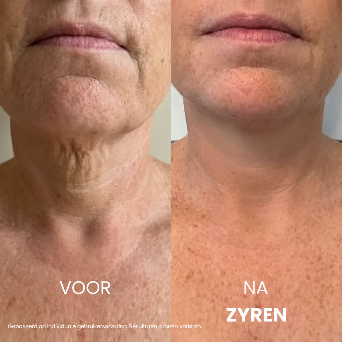 Zyren® halscrèmes voor strakker en lifter