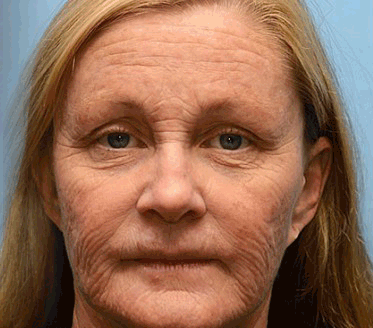 [🔥Laatste dag 70% korting] ODALIT™ Botox- en Retinol-shot - Verwijderaar voor diepe rimpels, doorhangende kaaklijn en opgezwollen ogen