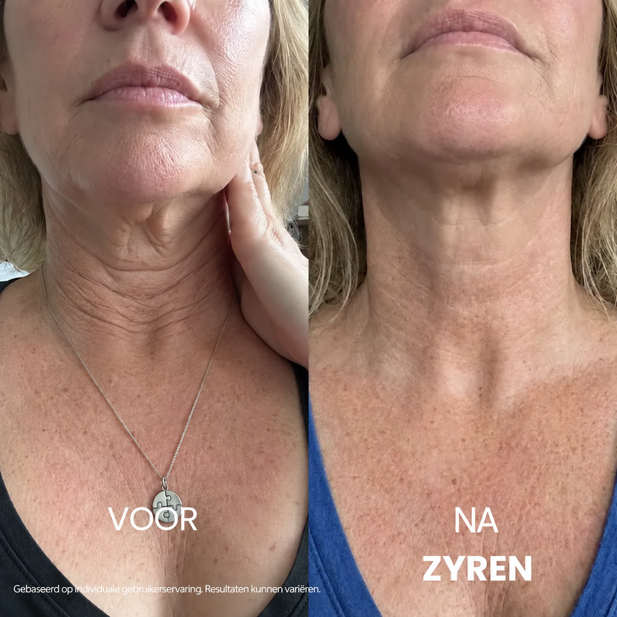 Zyren® halscrèmes voor strakker en lifter