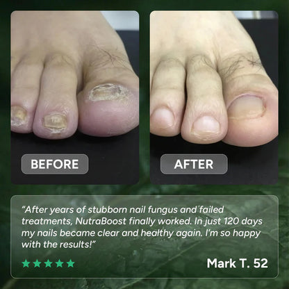 GEL VOOR DE BEHANDELING VAN NAGELSCHIMMEL